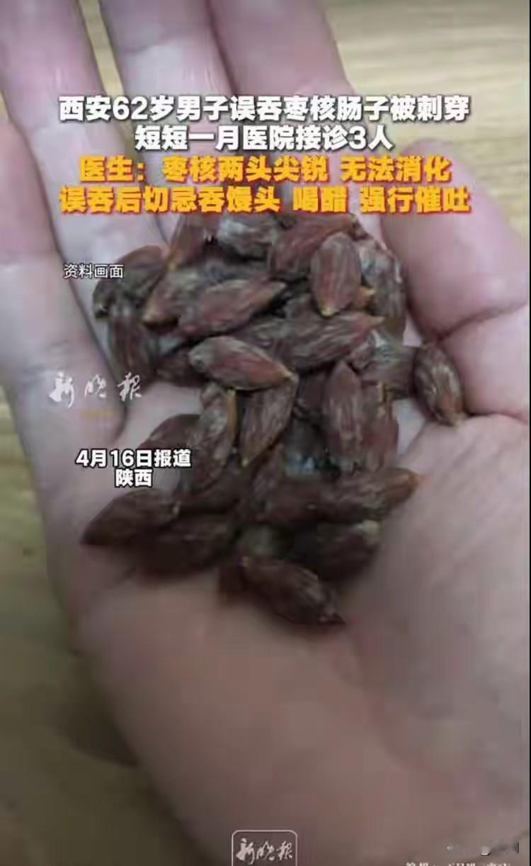 西安一男子误吞枣核致肠穿孔！医院一月接诊3例，这些错误做法千万别做
 
近日，陕