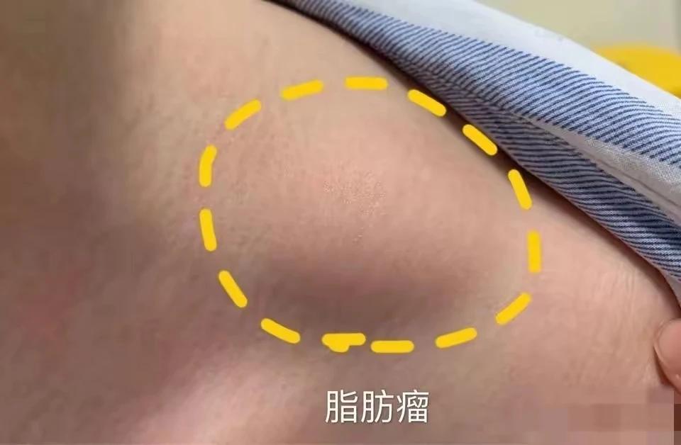 脂肪瘤是困扰许多人的问题，但是你知道吗？只需要两味药，久服，就能帮助你消融腹中的
