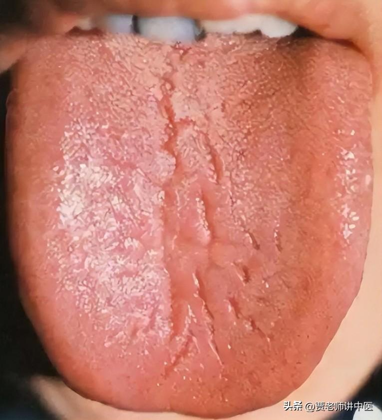 中医提醒：裂纹舌也分阴阳，千万别乱补，一分钟教你如何区分！

1.阴虚裂纹舌
舌
