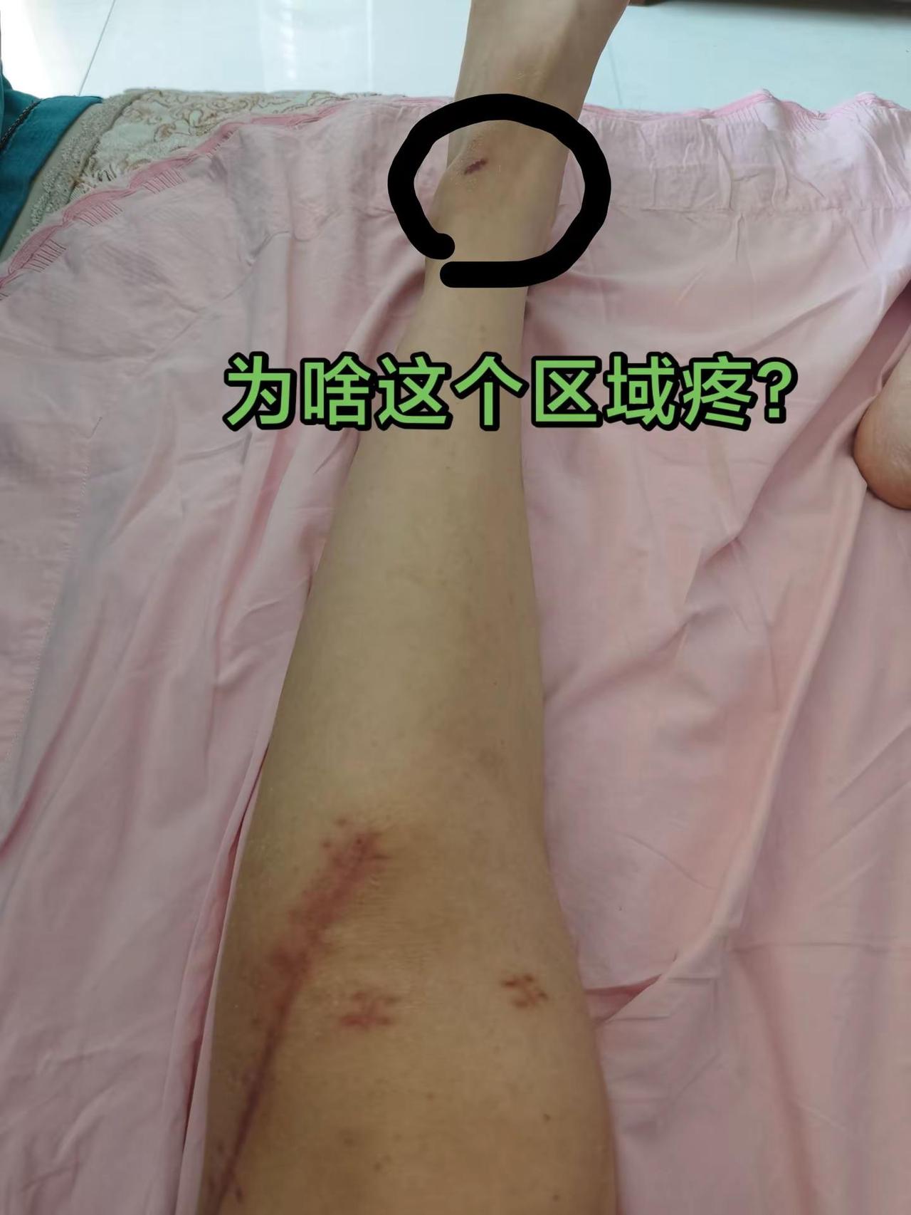 骨折受伤后我也不疼，手术后我也没觉得怎么疼，为啥挨地后这个地方疼的忍不了？这是康