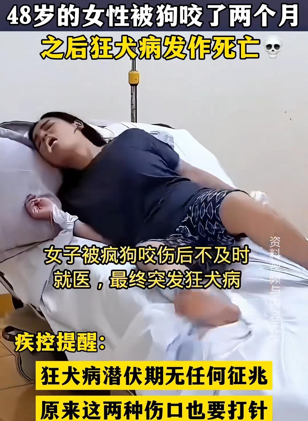 48岁女士被狗咬后狂犬病发作死亡！养猫狗的你，这几点一定要知道
 
一位48岁女