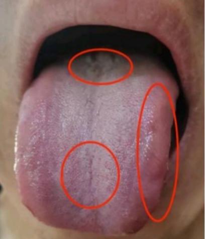 男人舌头一旦出现这三点，不是微软不起，就是阴囊潮湿，前列腺炎！
 
1：舌根不仅