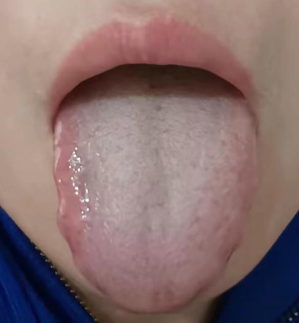 男人行不行，是否出现这3种舌象是重中之重，出现一种就晚了

1️⃣ 肝失疏泄：舌