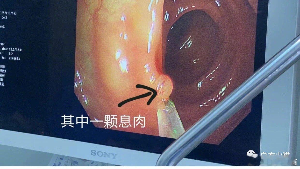 父母给你生肠癌的命，老天给了你五年时间去改命，你愿意去改吗？我的一位朋友，47岁