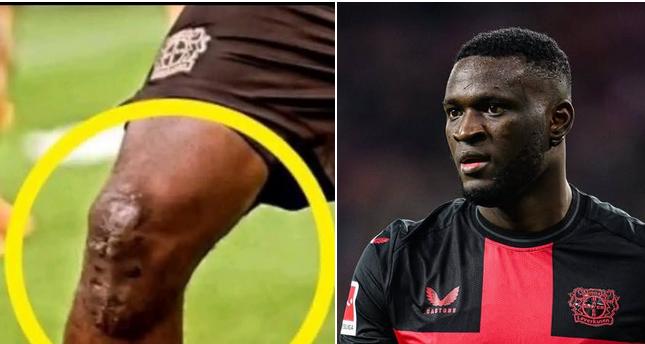 博尼法斯赛季报销，赛季前这位尼日利亚前锋一度接近米兰，但是体检没过。
这老哥的膝