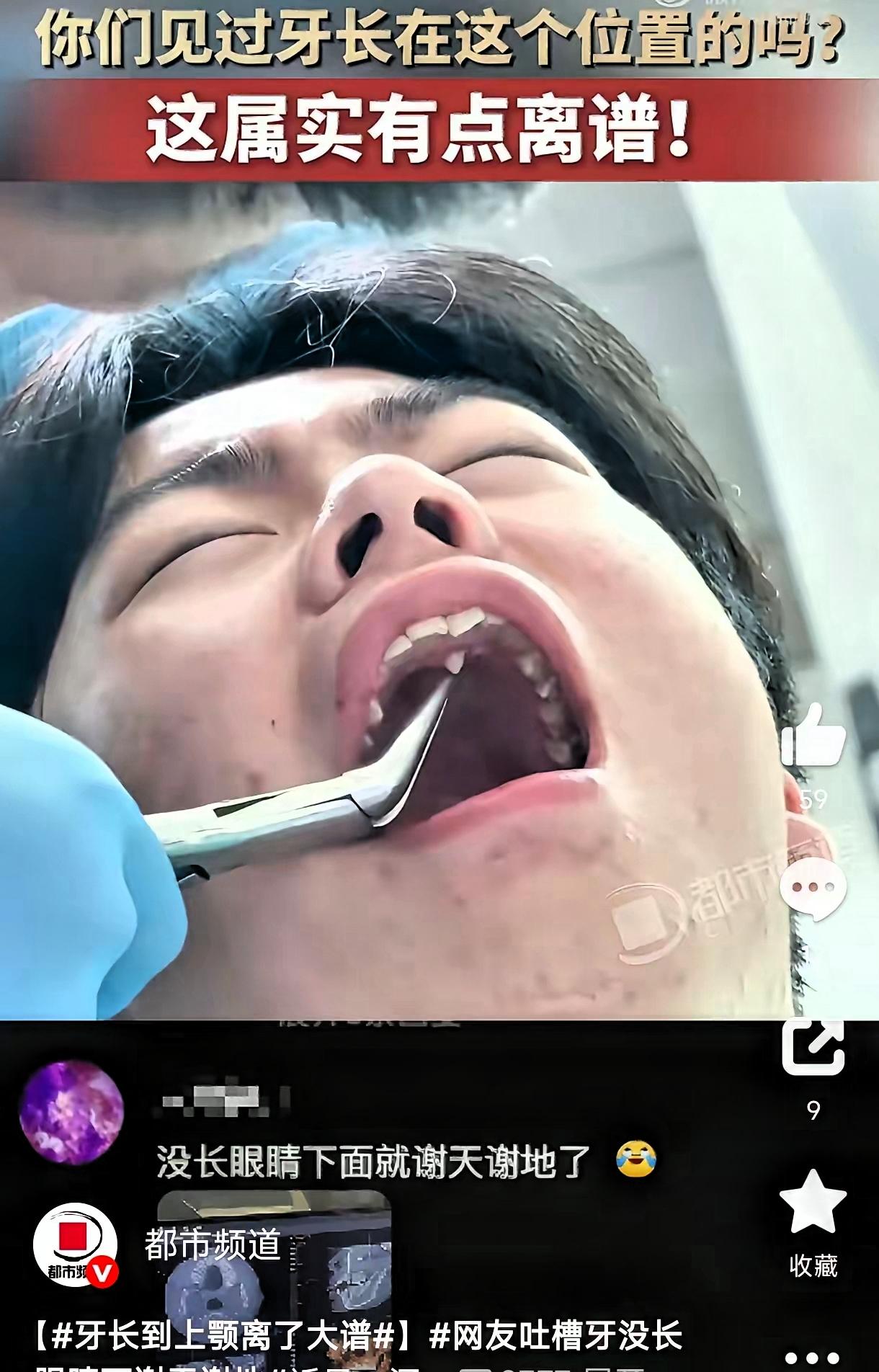 笑不活了！河北，一小伙因为牙疼去牙科拔牙，结果医生检查时发现，他的牙齿竟然长在了