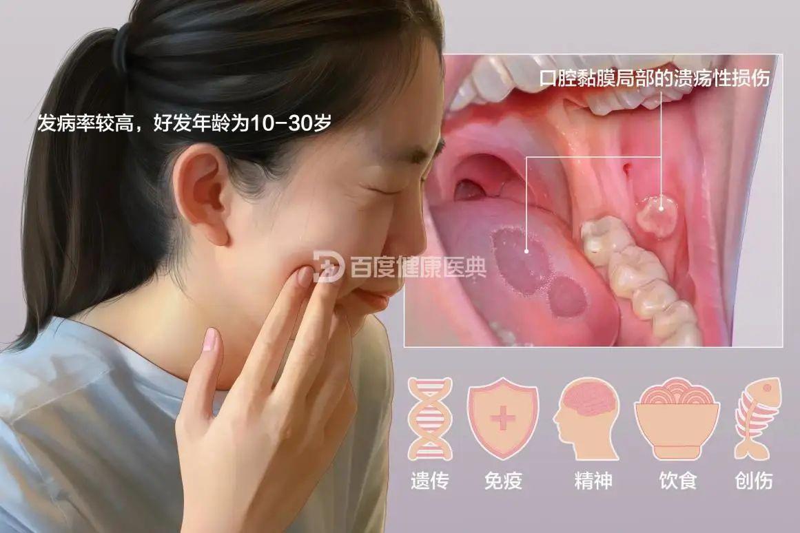 最常见的类型是复发性阿弗他溃疡，我国约10%~25%的人受其困扰，好发于10~3