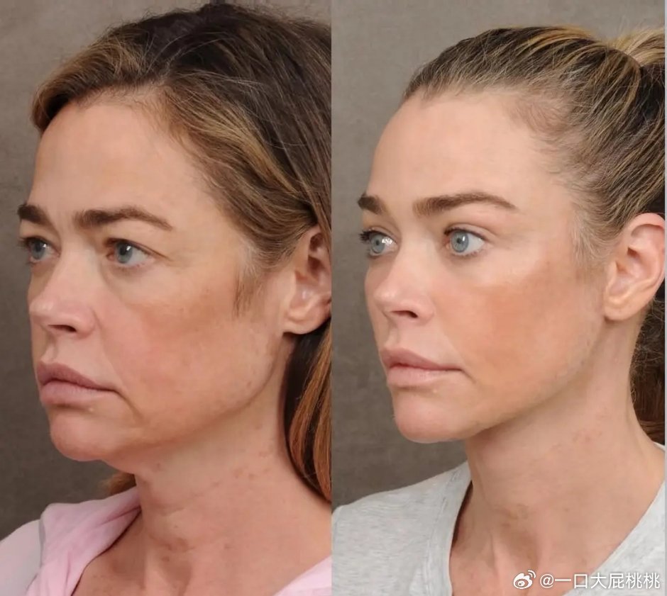 这个拉皮手术好自然 