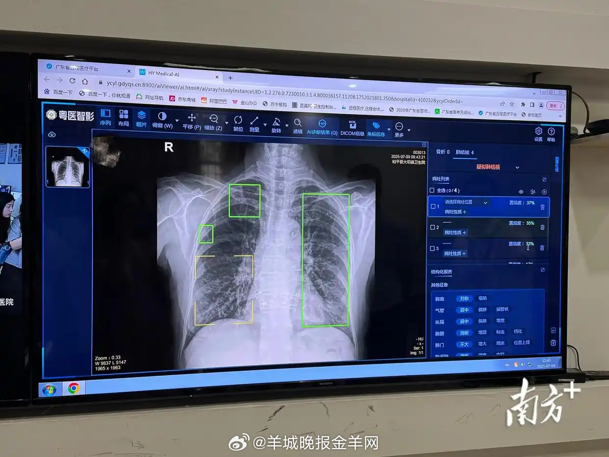 【#广东人工智能辅助影像阅片系统全面上线# 2秒出报告！乡镇医院都用上AI阅片了