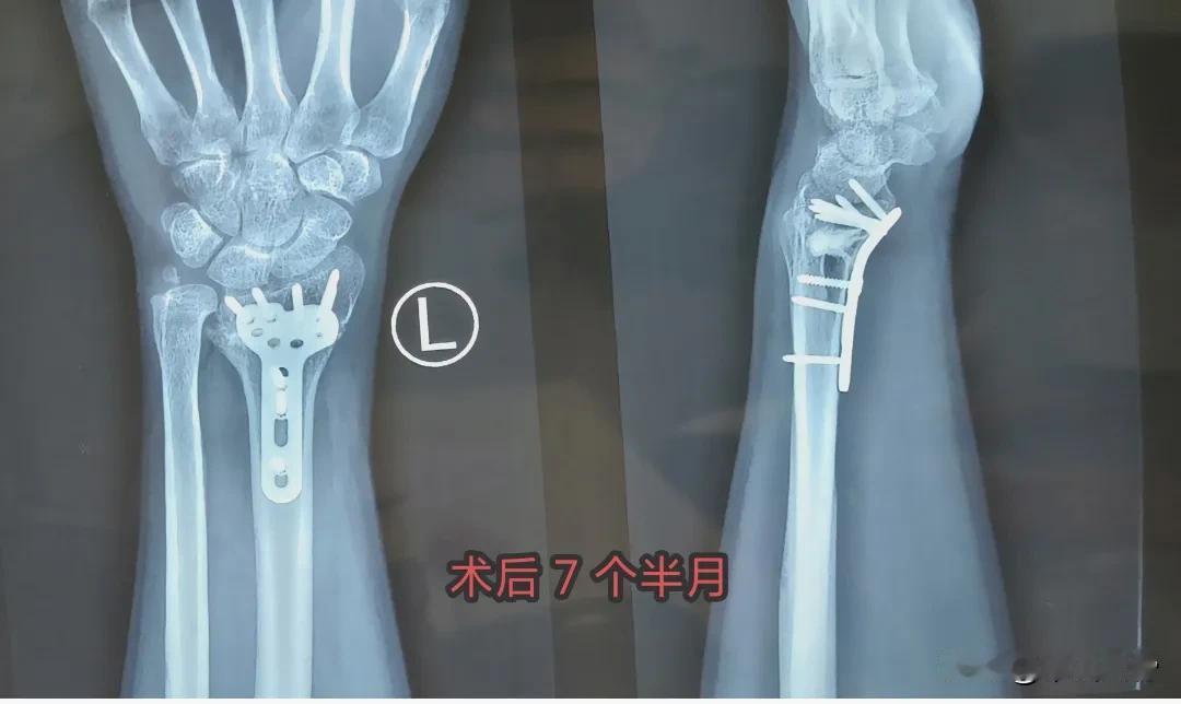 麻烦大夫给看看，这个恢复的咋样？左桡骨远端
