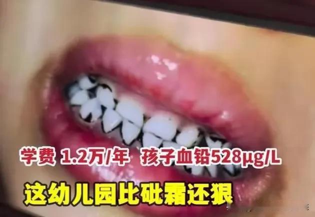 天水幼儿园的惨剧令人震惊，200多个孩子铅中毒，大脑受到不可逆转的伤害，痛心之余