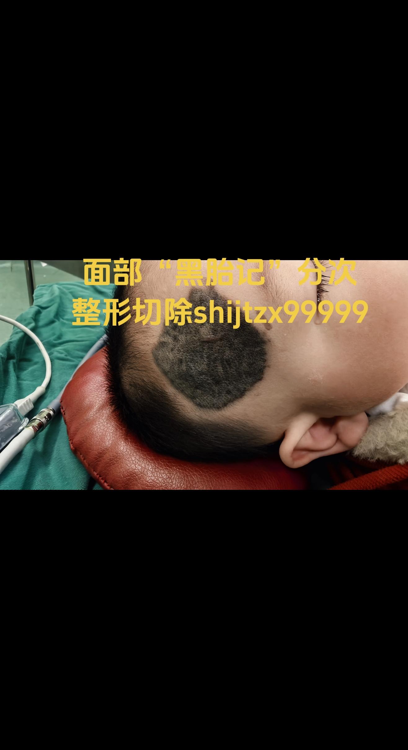 胎记。患儿出生时面部出现黑色“胎记”，曾做激光治疗，无效并出现疤痕，本...