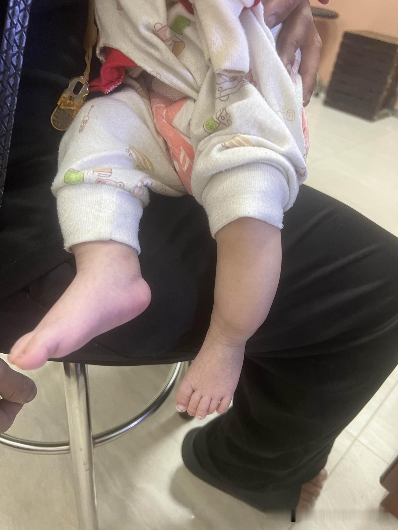 小孩小腿骨折，家长却不知道怎么回事？
2个月大的宝宝，家长发现左侧小腿有些肿，于