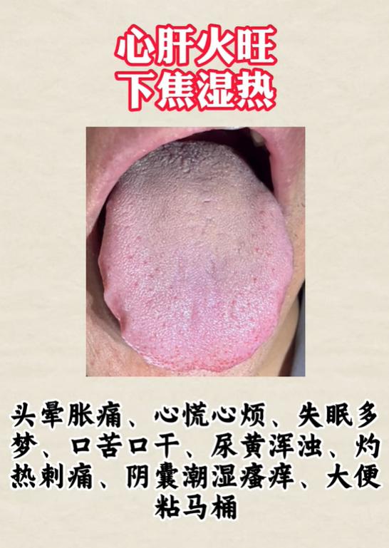 失眠潮湿、口干盗汗浑身发沉，3 种舌象分辨心肝湿热、脾胃阴虚、脾虚夹心火