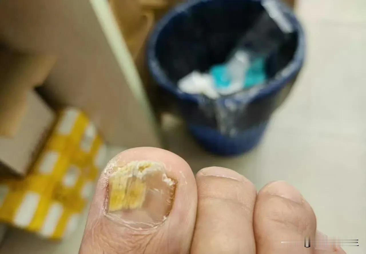 #请问现在治疗灰指甲有什么好方法吗#治疗灰指甲一直有更好的方法，就是口服抗真菌的