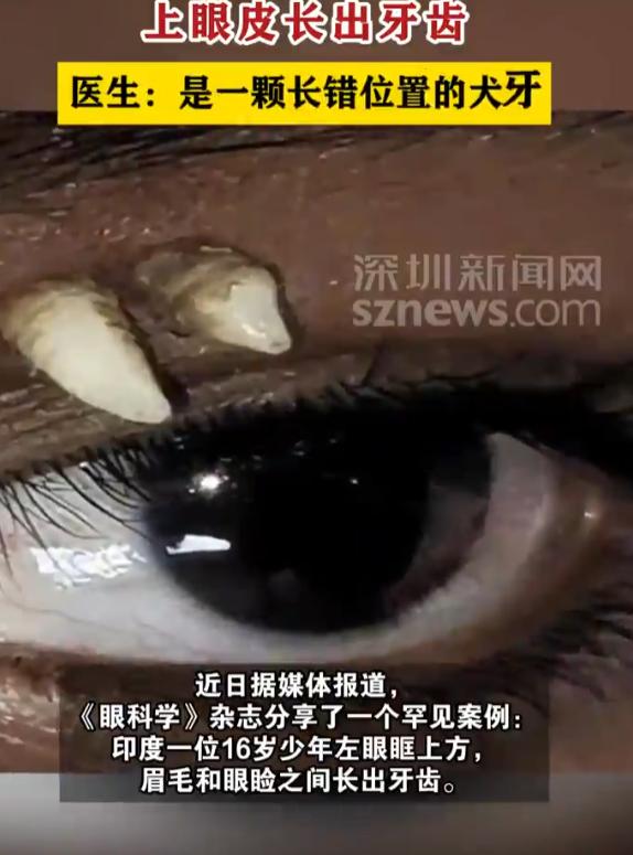 “活久见！”10月20日报道，印度，一16岁少年左上眼皮这个位置，竟然长了一颗牙