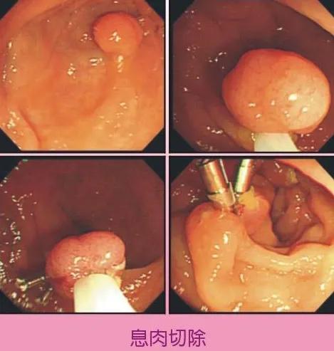 饿了一整天了，下午做完了肠息肉切除之后一直躺在病床上。从昨天晚餐开始，就简单一点