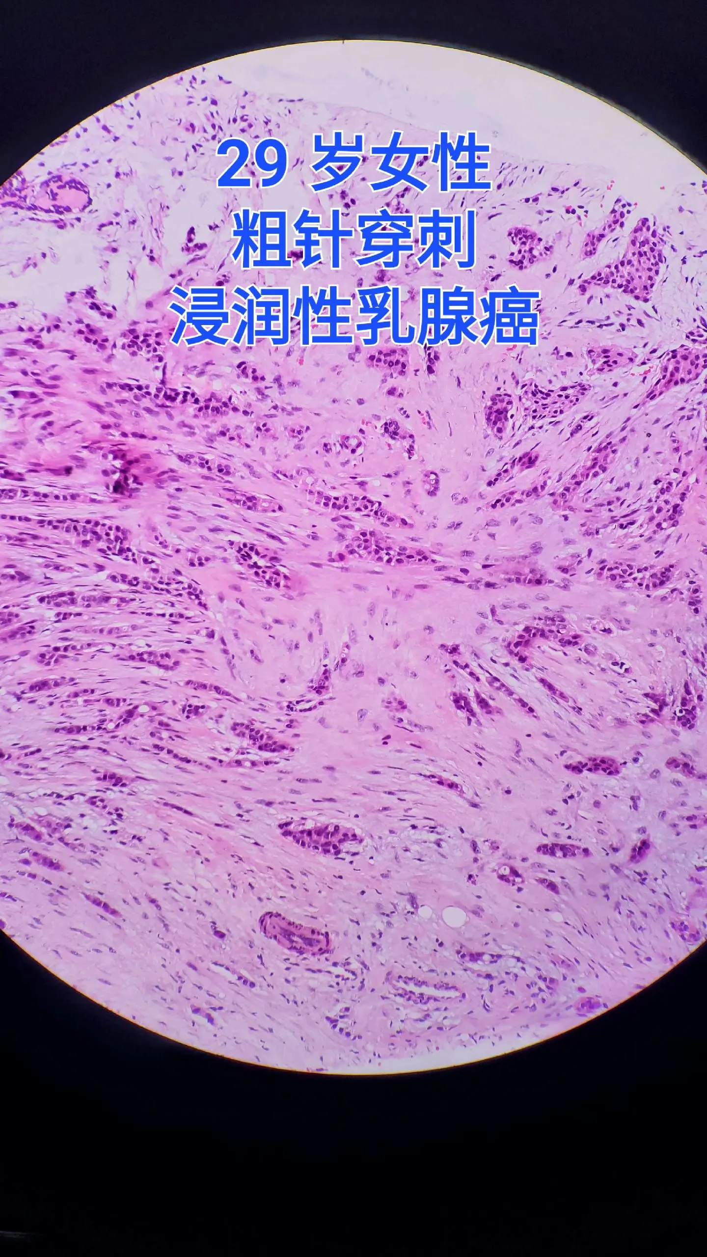乳腺癌 癌症年轻化