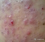 一位14岁女孩，面部长了非常多的痤疮，额头痤疮很大很密集，色红。问其饮食习惯，答