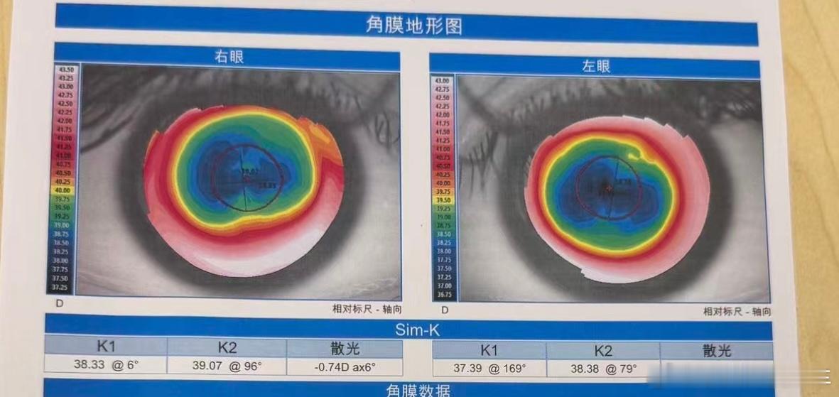 高度近视眼一定要防止视网膜脱落如果做过近视眼手术，那就更要多多注意！我是因为反弹