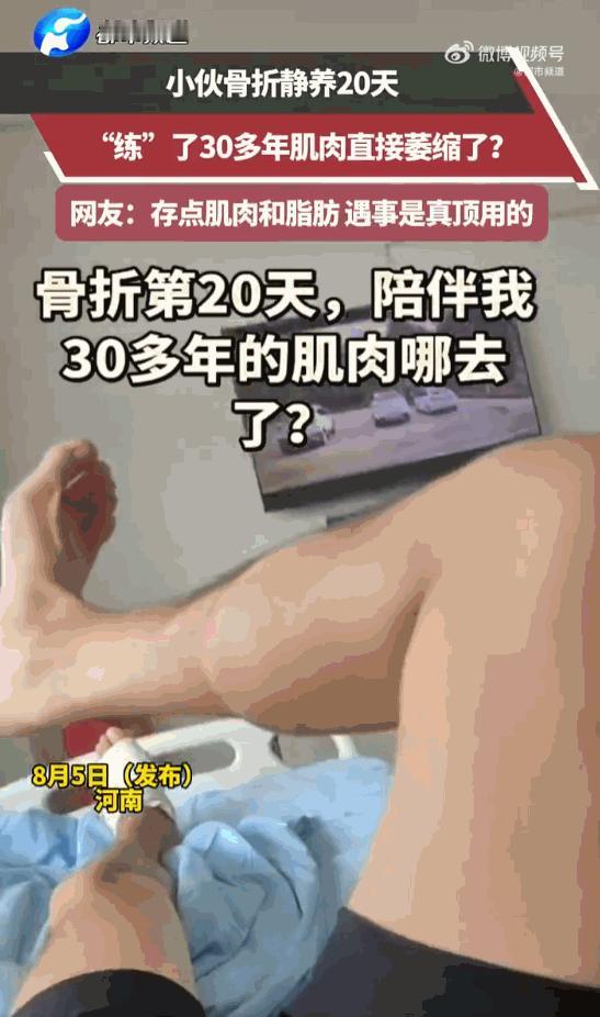 万万没想到！河南一小伙骨折后躺床静养，不料短短20天，练了30年的精壮小腿竟萎缩