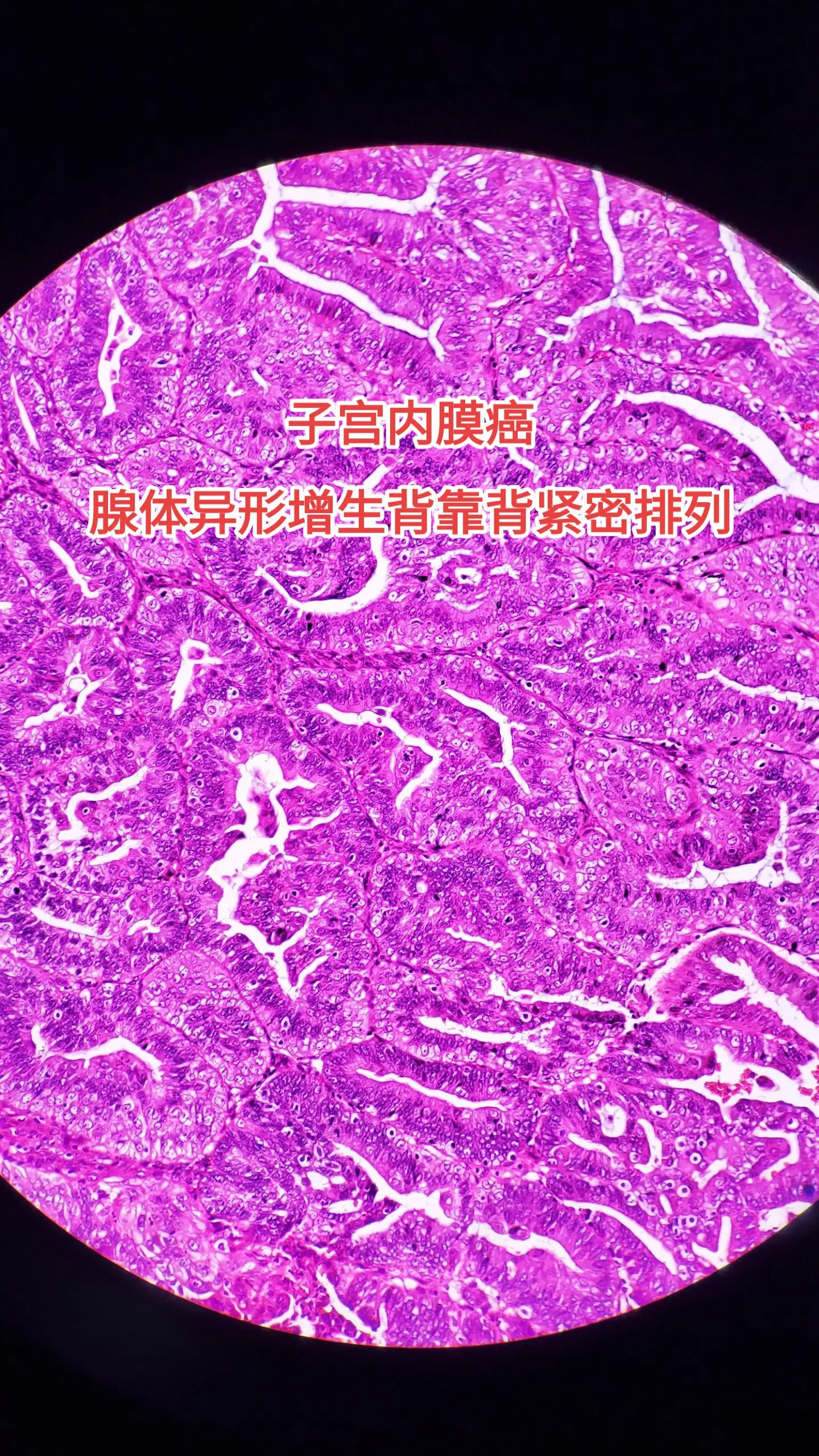 子宫内膜癌