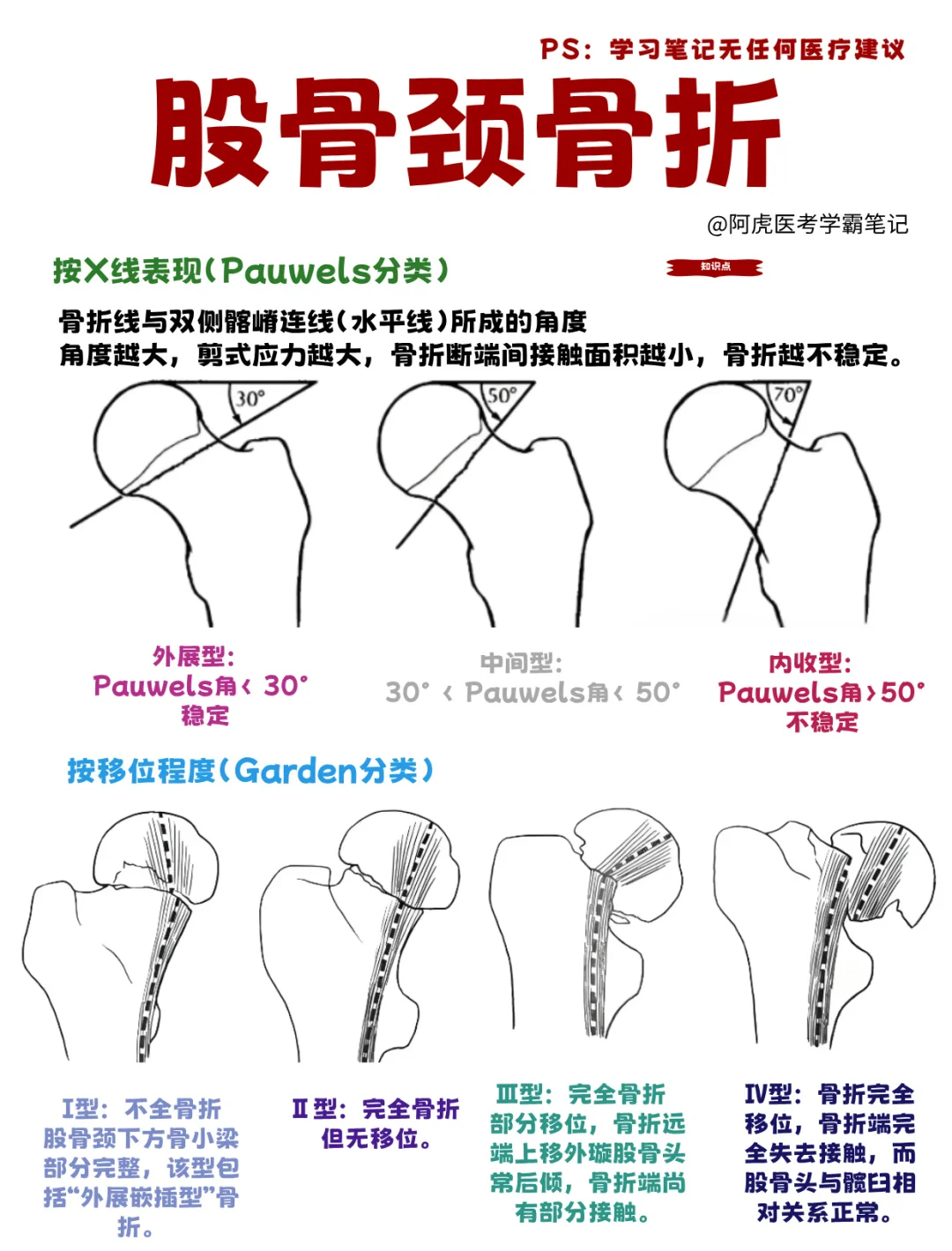 医学生笔记📒｜股骨颈骨折的分类👆