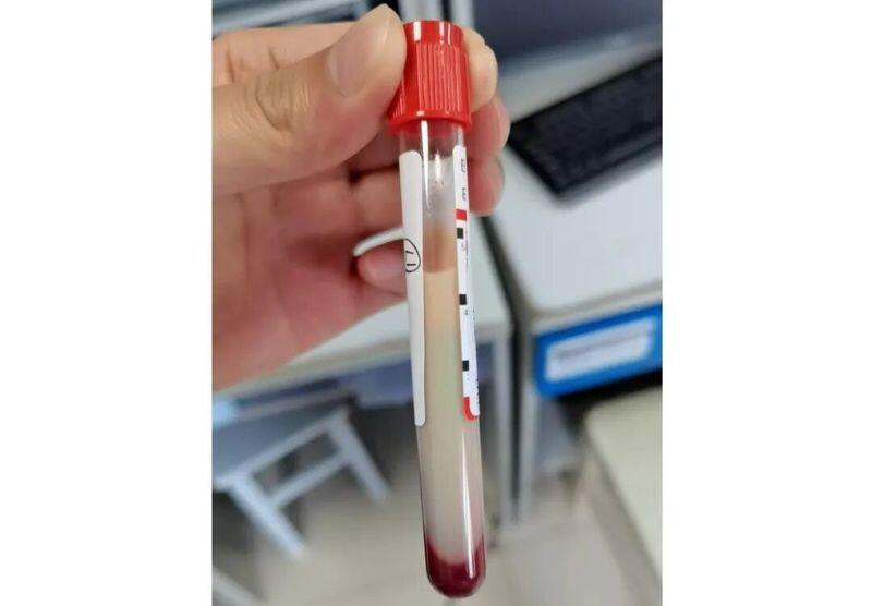 我去，这事儿听着都吓人。一个32岁的老哥，连着几天火锅配啤酒，结果直接把自己喝进