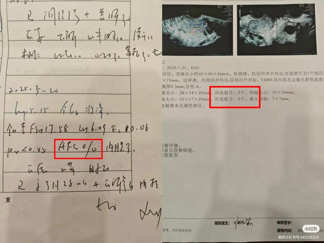 这位姐妹amh：0.18， 曾经监测显示卵泡情况不乐观，甚至一度面临“一个卵都没