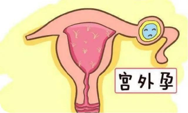 #健康真探社#【这些人，很容易惹上宫外孕！】论及妇产科抢救中最紧急的情况，宫外孕
