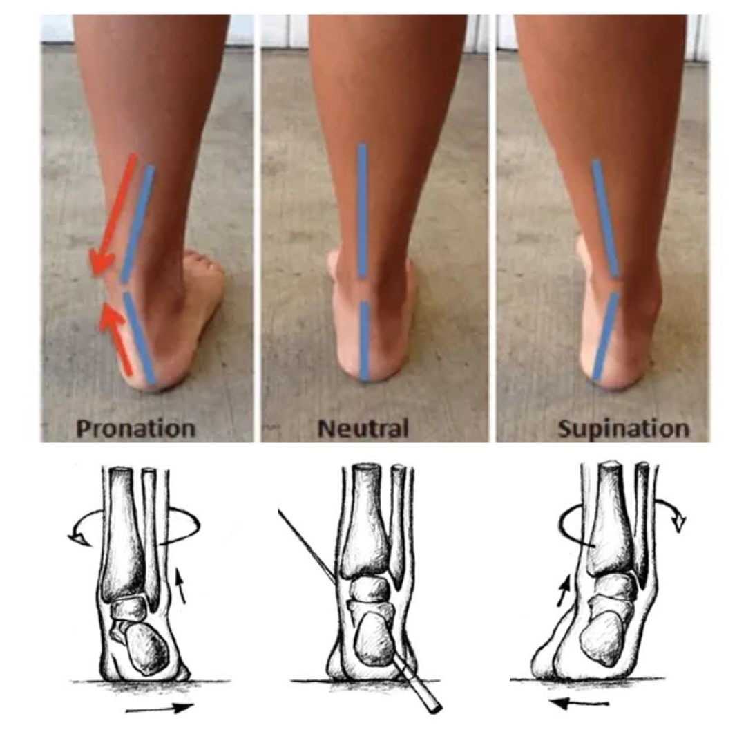 运动康复 你的下肢疼痛根源，可能就隐藏在你的脚里。来观察下自己的脚踝力线，你是1