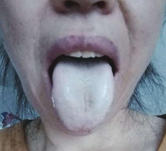 像这一位病友，年轻时候睡眠质量一般
绝经以后睡眠质量更差，长期彻夜难眠
她伸出舌