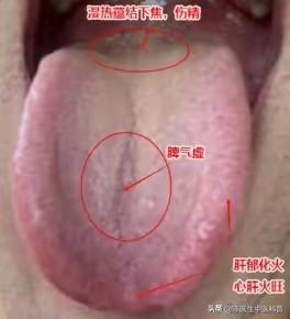 🧐 哪些舌头表现不适合吃右归丸？
 
1. 舌头胖大且有齿痕，同时舌苔黄腻
这
