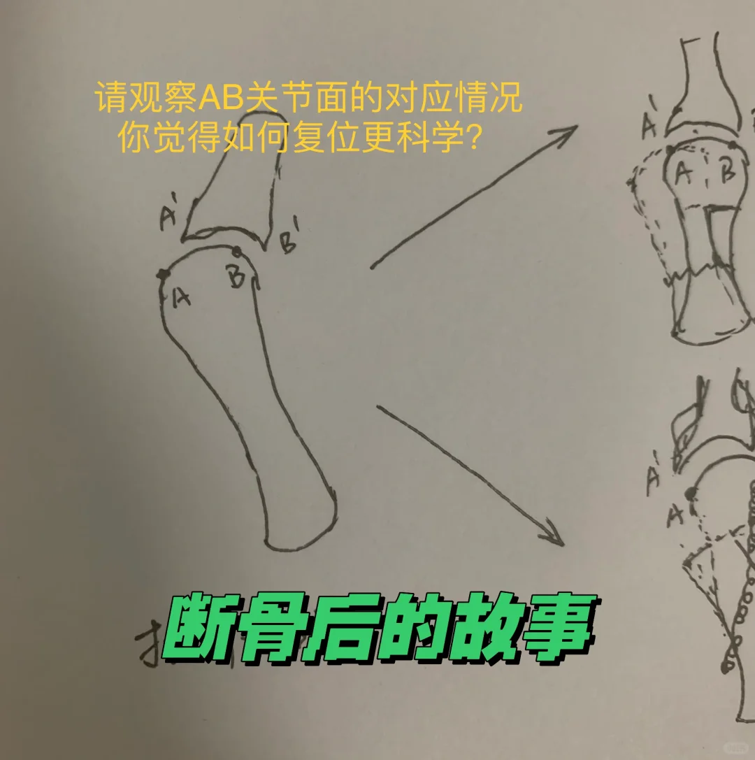 拇外翻手术断骨后的故事