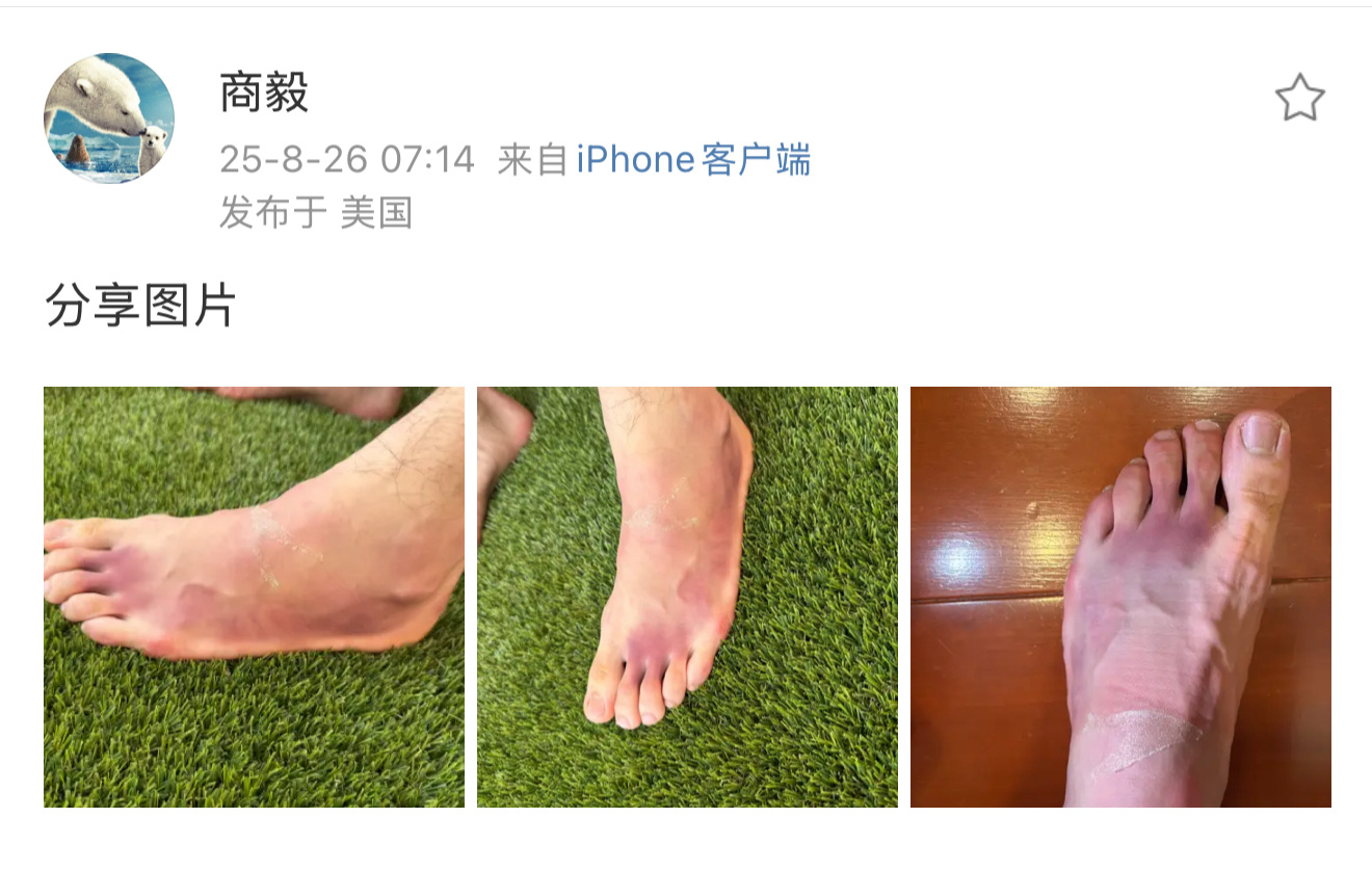 小商的手术是右脚，这次伤的是左脚。 ​​​