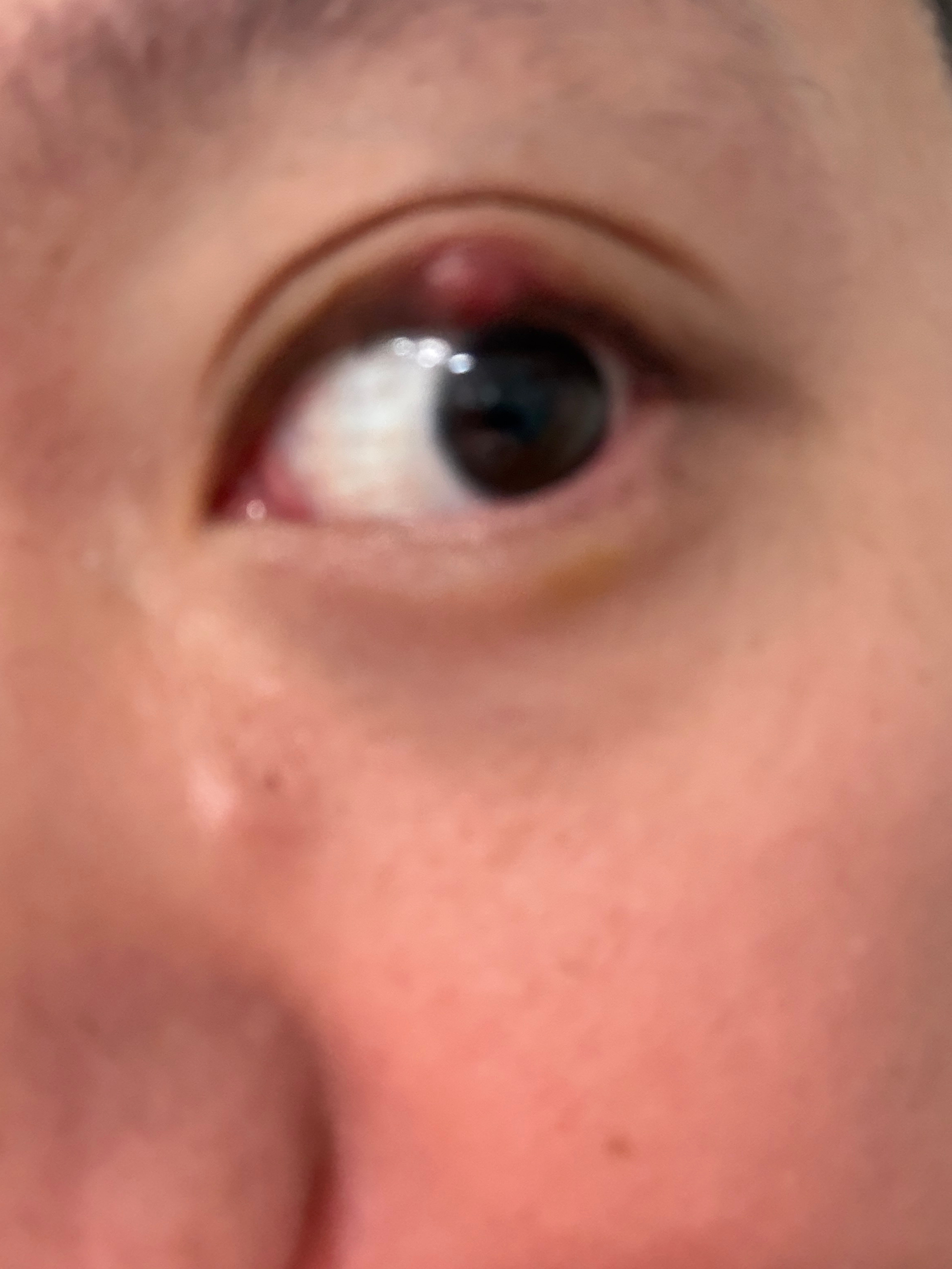 眼皮上长了个小疙瘩，说是美女看多了，以后要少看点美女了