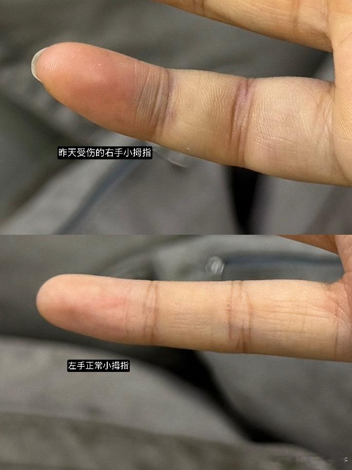 幸好，小拇指没断，就是还动不了