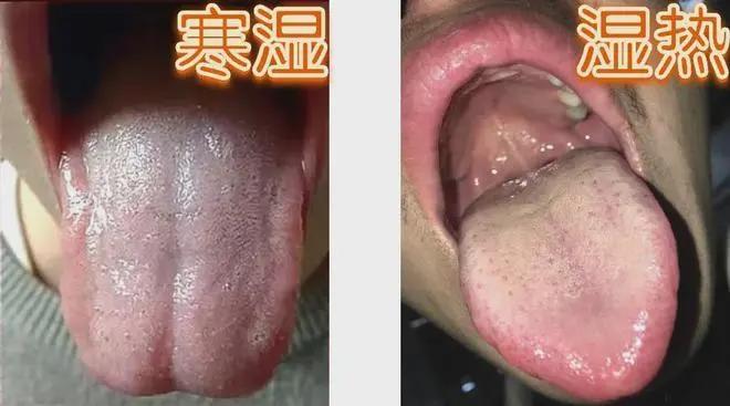 口干口渴，小心是湿热
身体湿热内蕴，就会导致气机失调，津液不能正常输布，表现为口