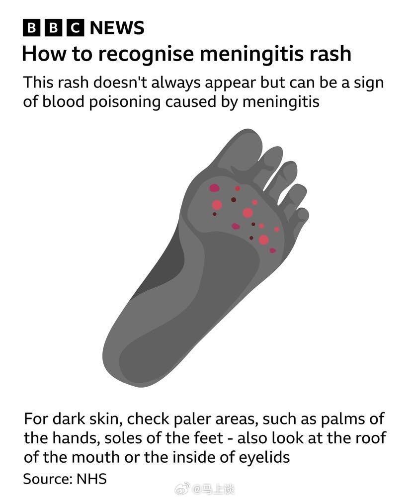 又是电子烟？英国夜店脑膜炎扩散到法国后再次传到伦敦。伦敦第一例脑膜炎是个孩子，目