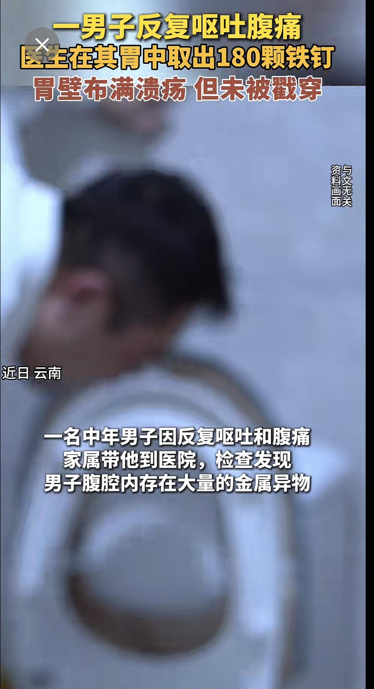 一男子反复呕吐腹痛，医生在其胃中取出180颗铁钉，胃壁布满溃疡，但未被戳穿。