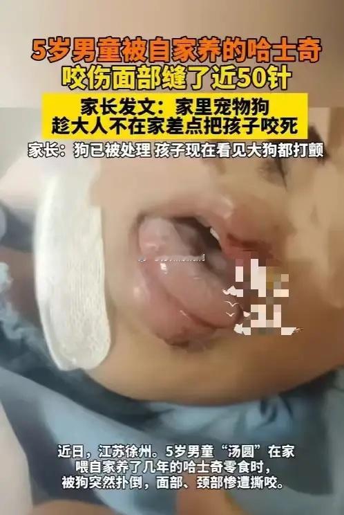“养狗养出大祸了！”家里那只哈士奇，平时是宠物，趁大人不在家却咬向5岁孩子的脸，