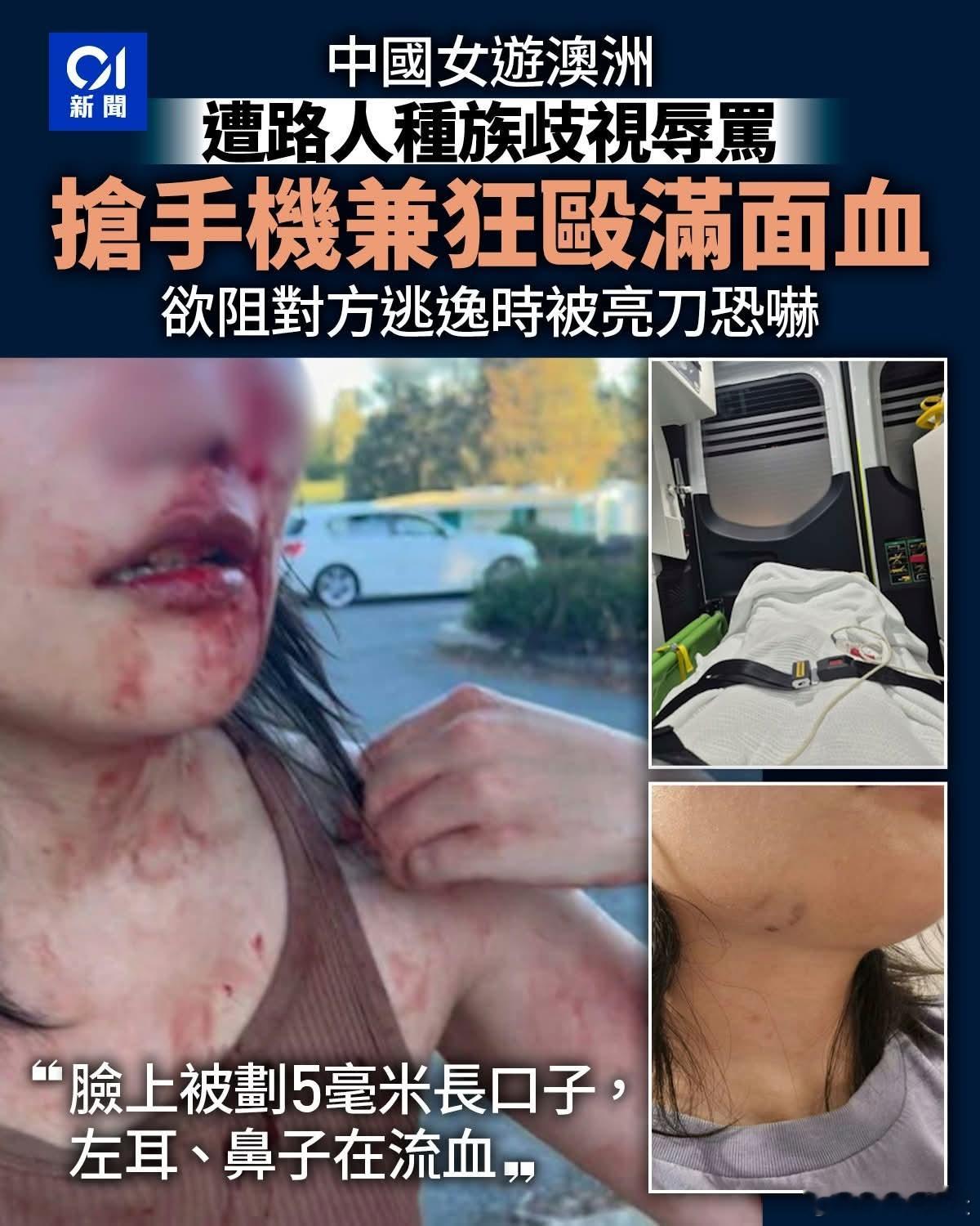 27岁中国女澳大利亚遇种族歧视被打到满脸血据《新西兰中文先驱网》报道，4月2日下