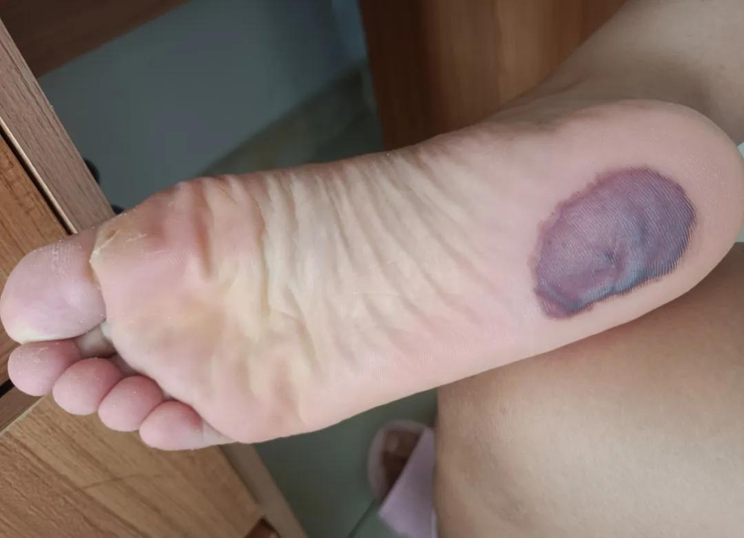 踩指压板，脚底磨出一个超大血泡。

年初，踩指压板，先是在指压板上垫毛巾，适应了