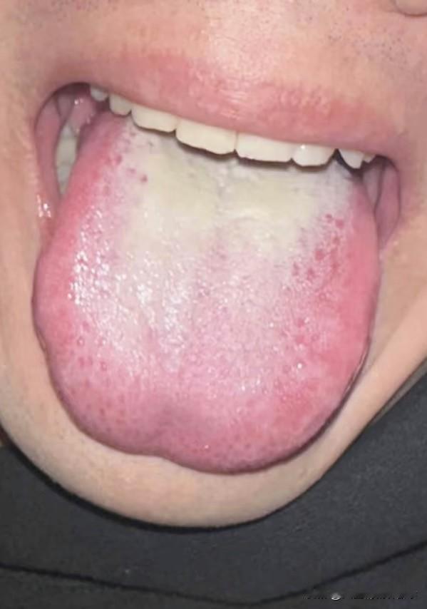 这种舌象，不要补阳，也不要清热，否则身体只会越搞越垮！

33岁男性患者，主诉时