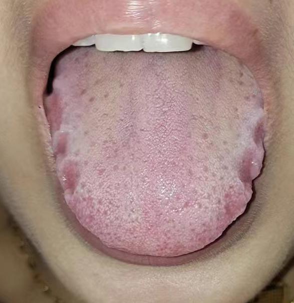 这种舌头还去湿热简直是胡来！不是所有的发黄都是湿热化火

这位来咨询的患者一上来