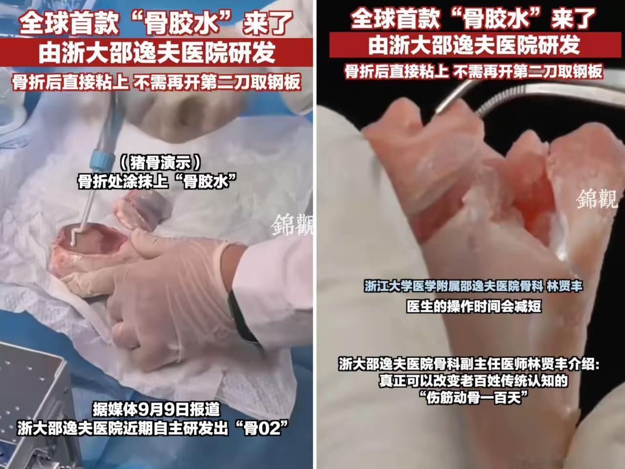 这下出名了，
不仅中国，连全世界都要知道了。
万万没想到，浙江邵逸夫医院研发出了