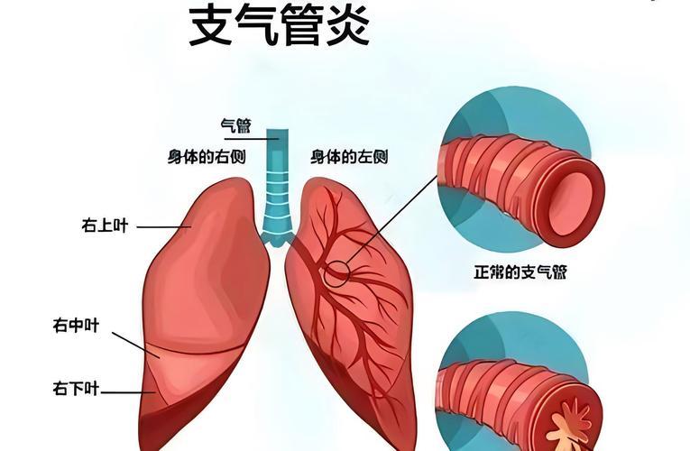 得了慢性支气管炎，喝点对症的茶饮能舒服不少。我首推蜂蜜柚子茶，柚子富含维生素 C