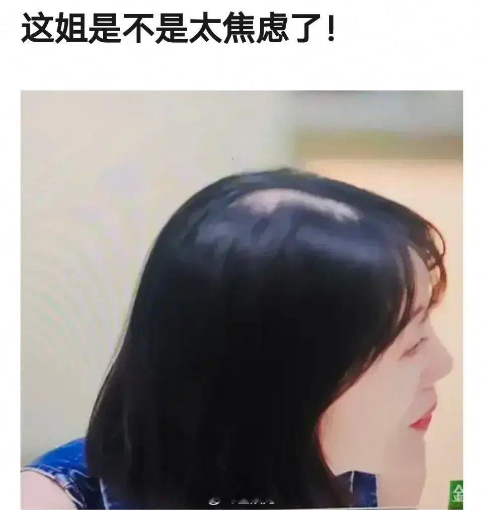 李溪芮头顶挺吓人的，既然已经秃成这样了[裂开] ​​​