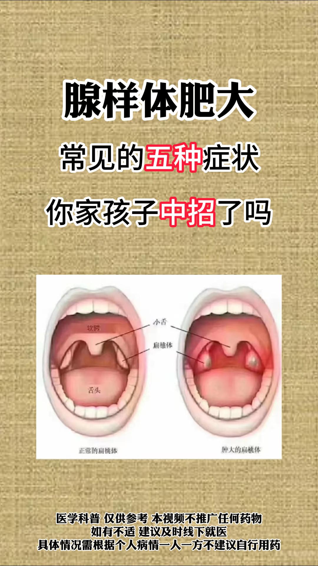 医学科普 腺样体肥大 育儿经验分享 图文热点来了