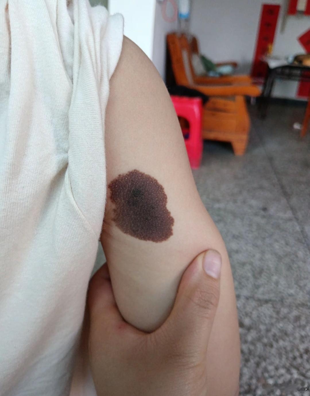 这种色素痣大多数都是良性的，现在医学发达了，可以尽早处理的！ ​​​